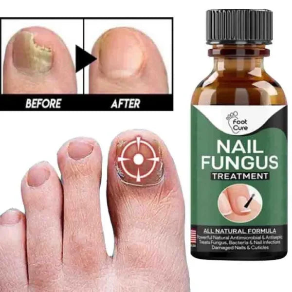 Fast Nail Fungal Treatments Nail Repair Essences Serum Care Treatments Foot Nail Fungus Removal Gel